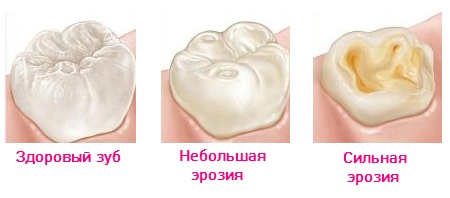Эрозия эмали на разных стадиях в сравнении со здоровым зубом Стадии эрозии эмали