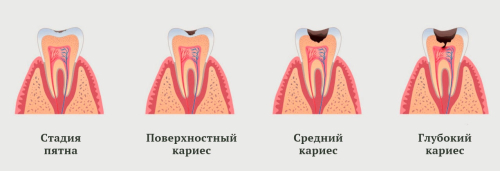 Стадии кариеса