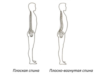 Плоская и плосковогнутая спина