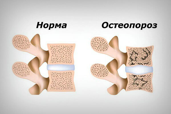 Остеопороз