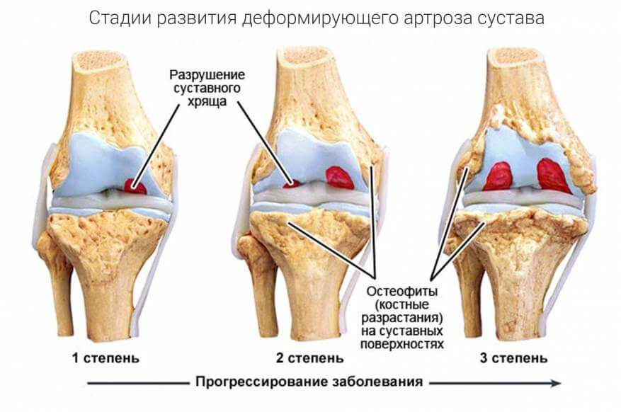 Стадии остеоартроза