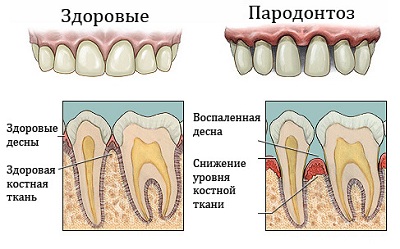Пародонтоз