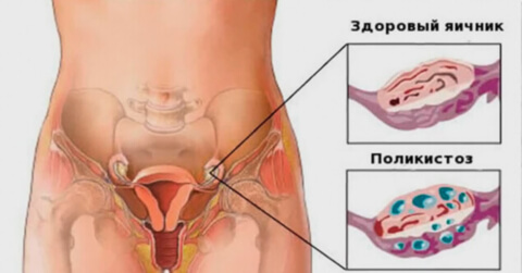 Здоровый яичник и яичник, пораженный поликистозом