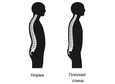 Плоская спина