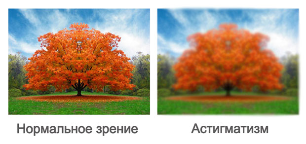 Астигматизм зрение