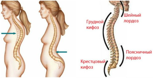 Как выглядит лордоз и кифоз Лордоз и кифоз